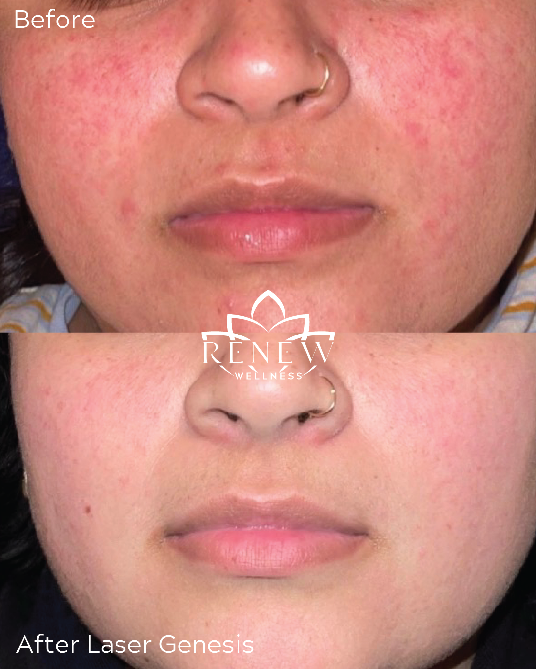 Laser Genesis before and after showing reduced redness and more even skin tone