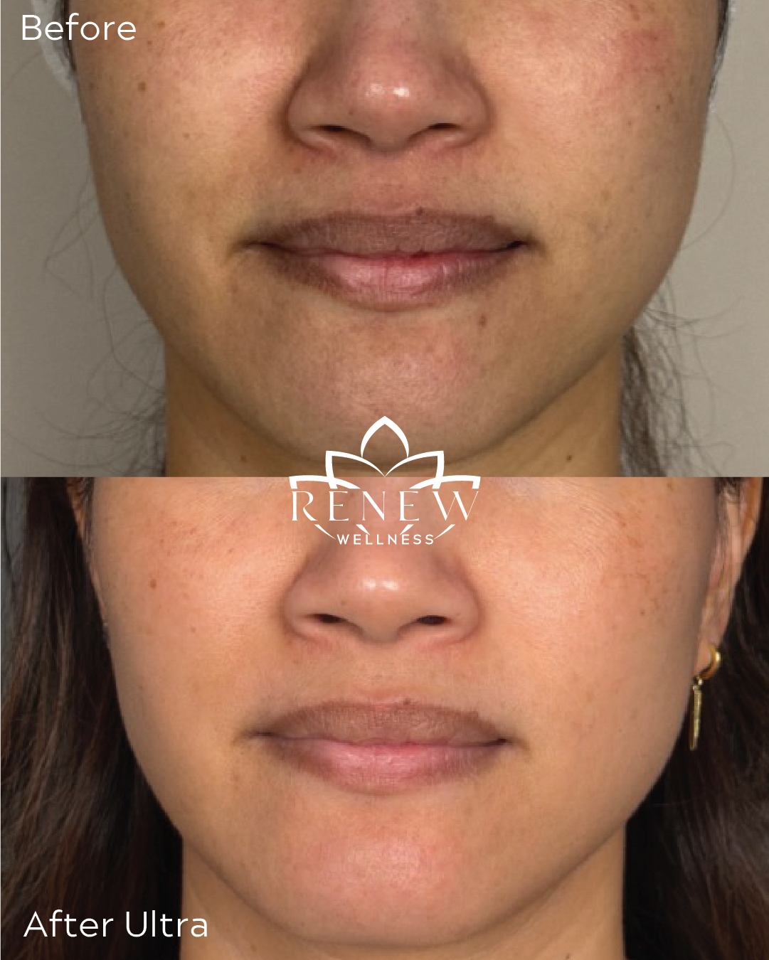 LaseMD Ultra treatment before and after showing improved clarity