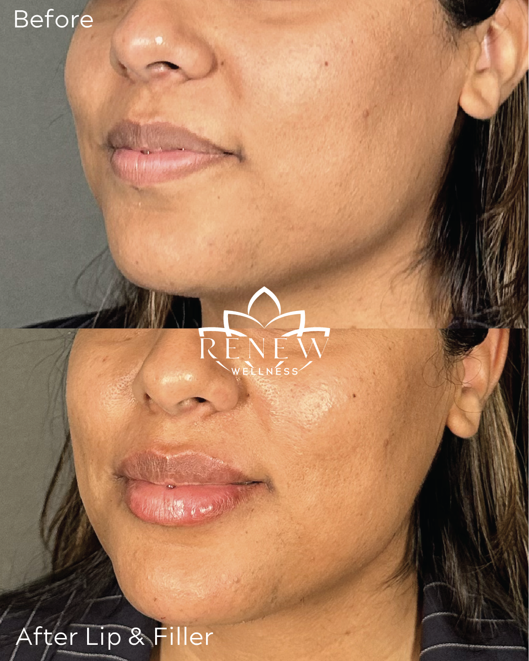 Lip and chin filler before and after showing improved lip definition and chin balance