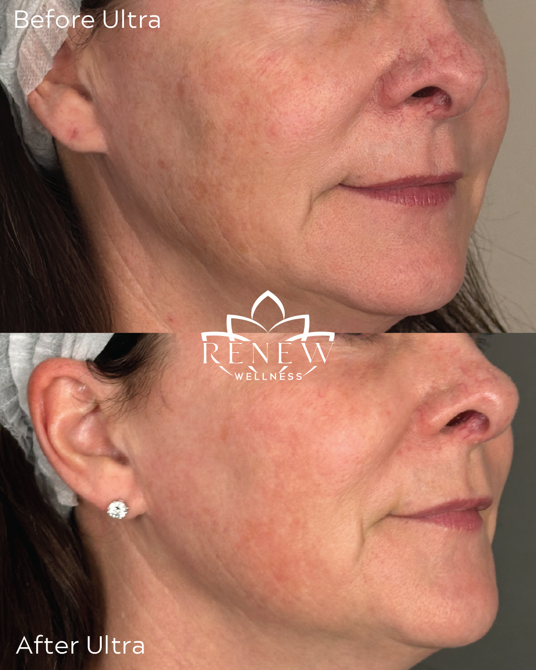 LaseMD Ultra before and after showing smoother texture across the cheek, jawline, and neck