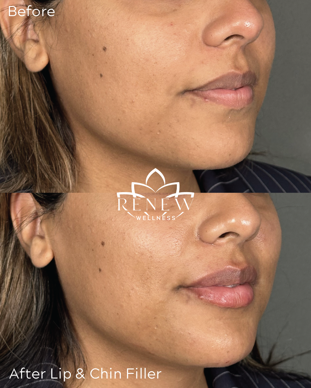 Lip and chin filler before and after showing enhanced lip volume and improved chin profile