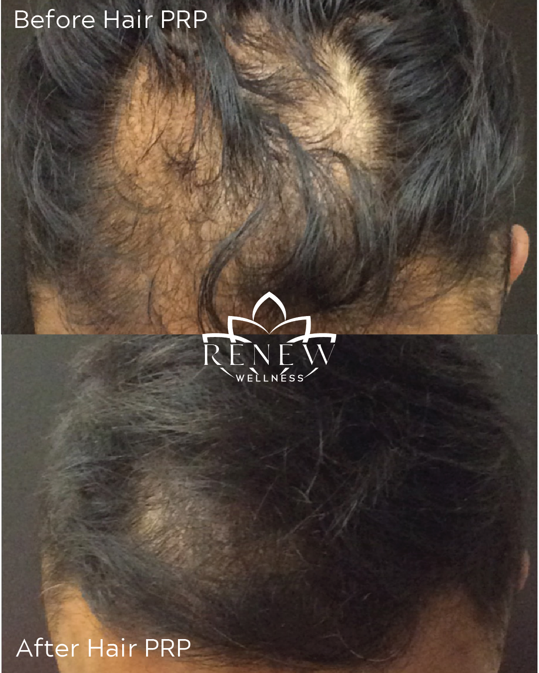 Hair PRP before and after showing denser hair growth on the scalp