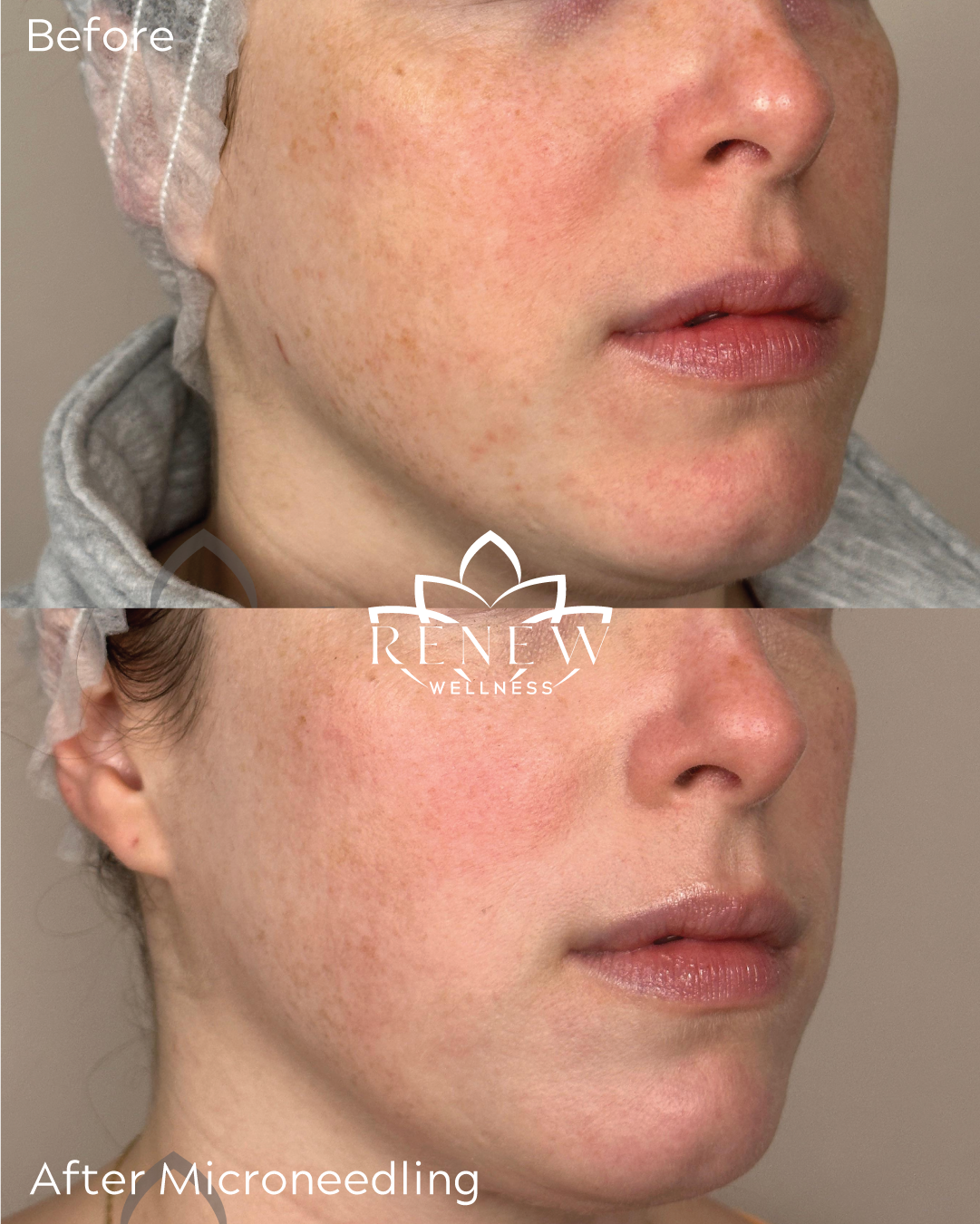 Microneedling before and after showing brighter, more even skin tone
