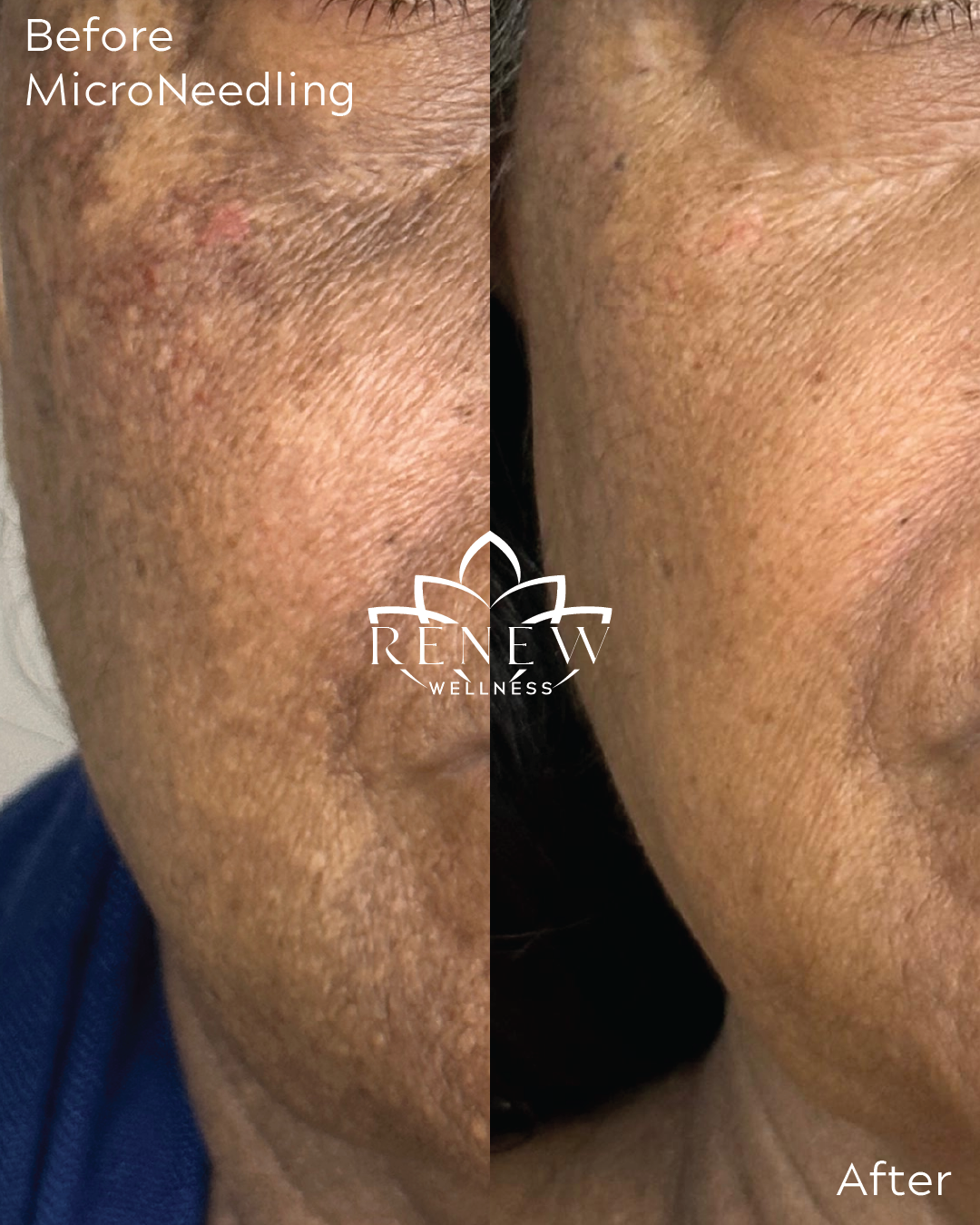 Side-by-side microneedling before and after on the cheek