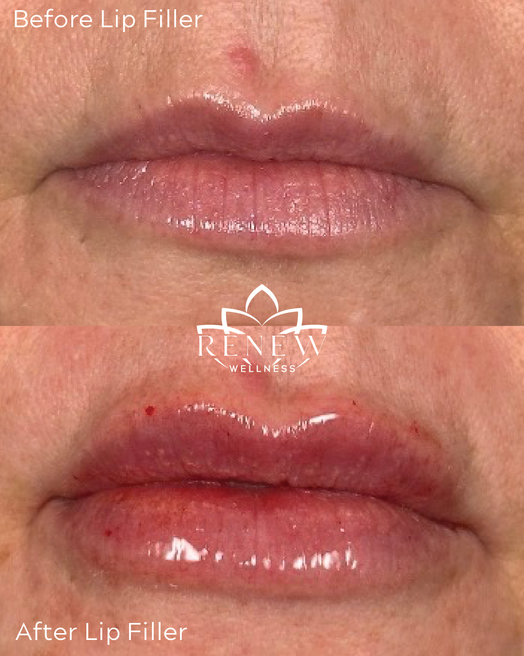 Lip filler before and after result 4 showing fuller, more defined lips
