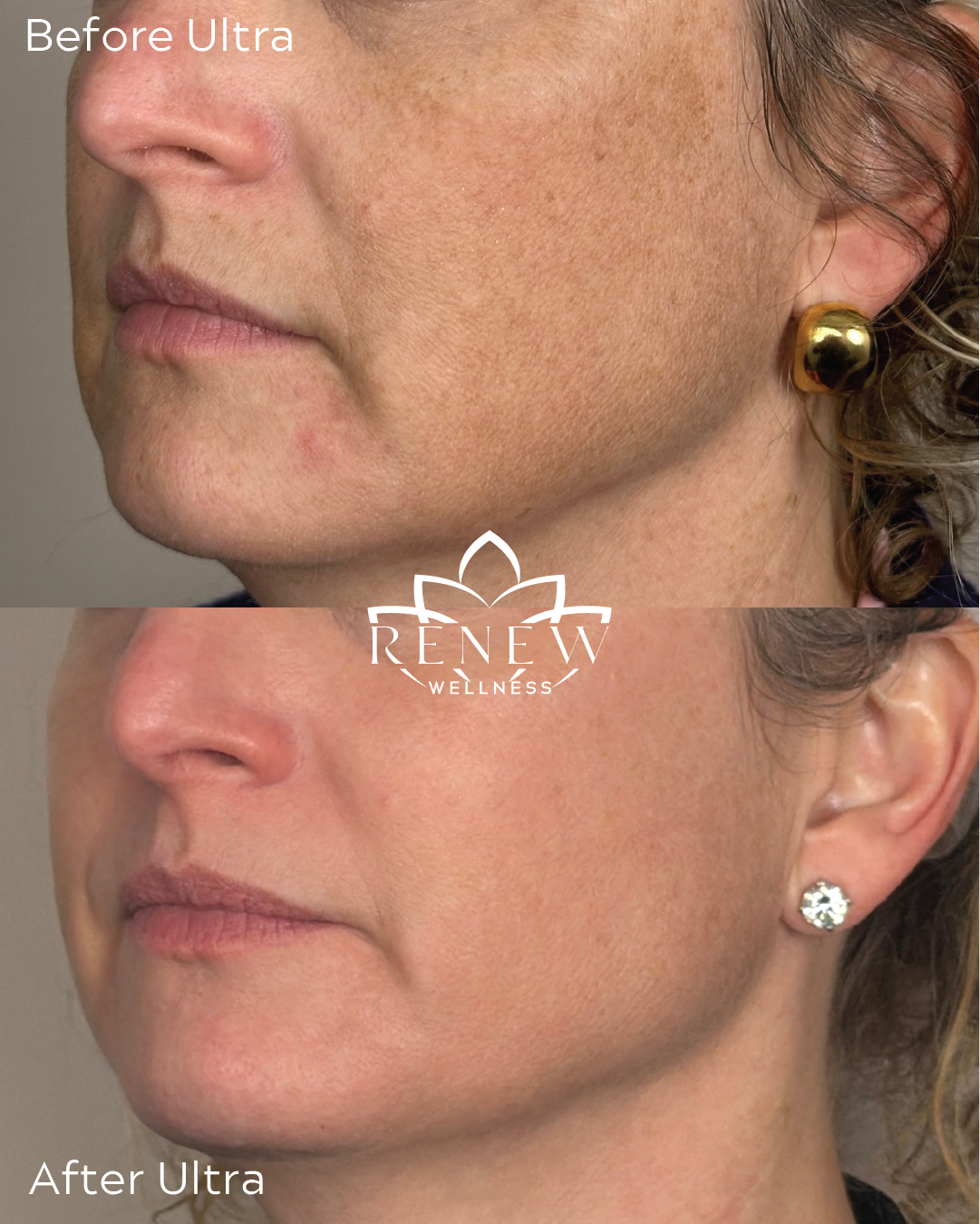 LaseMD Ultra before and after showing improved texture and tone from the cheek to the neck
