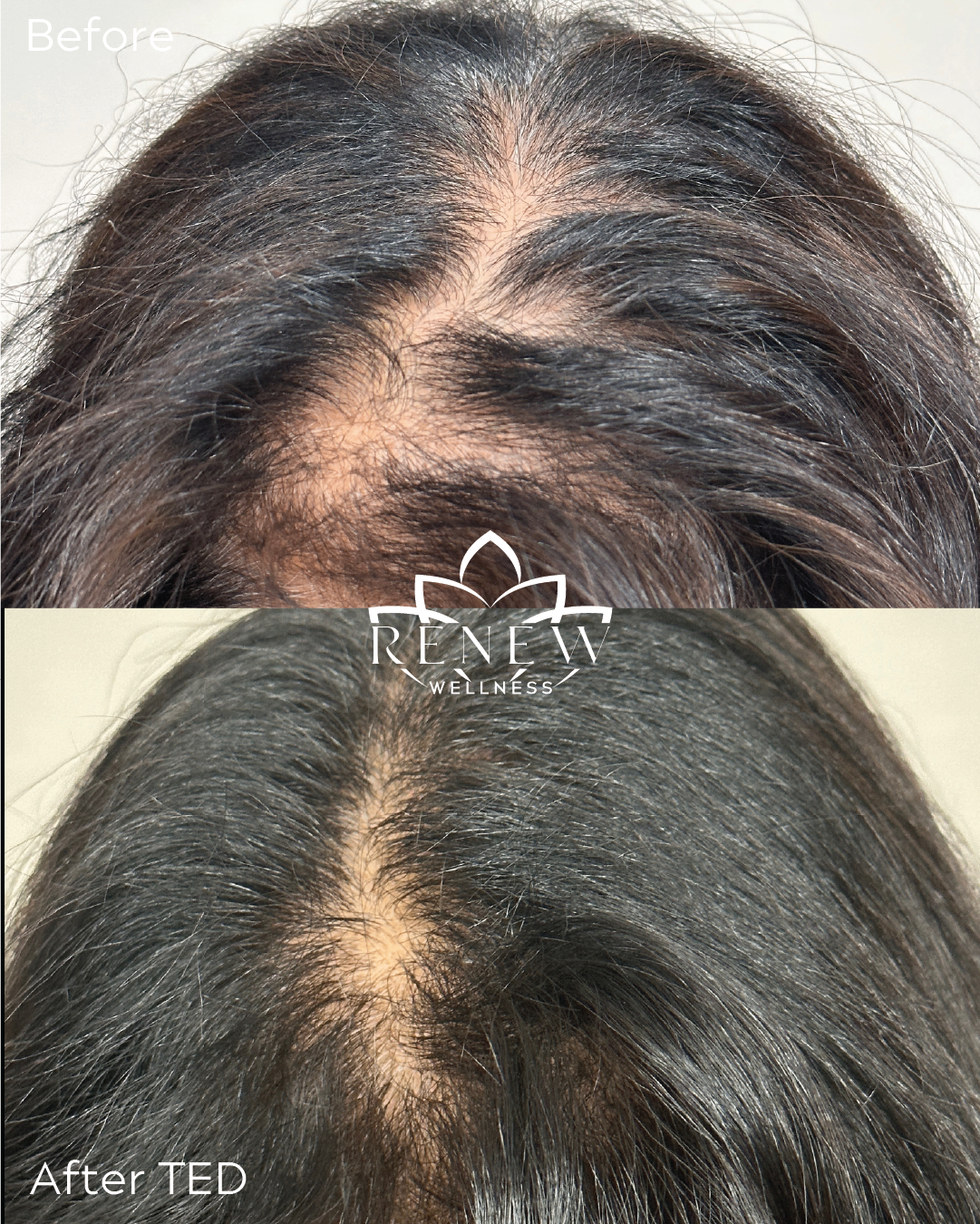 TED hair restoration before and after showing denser-looking hair at the scalp part