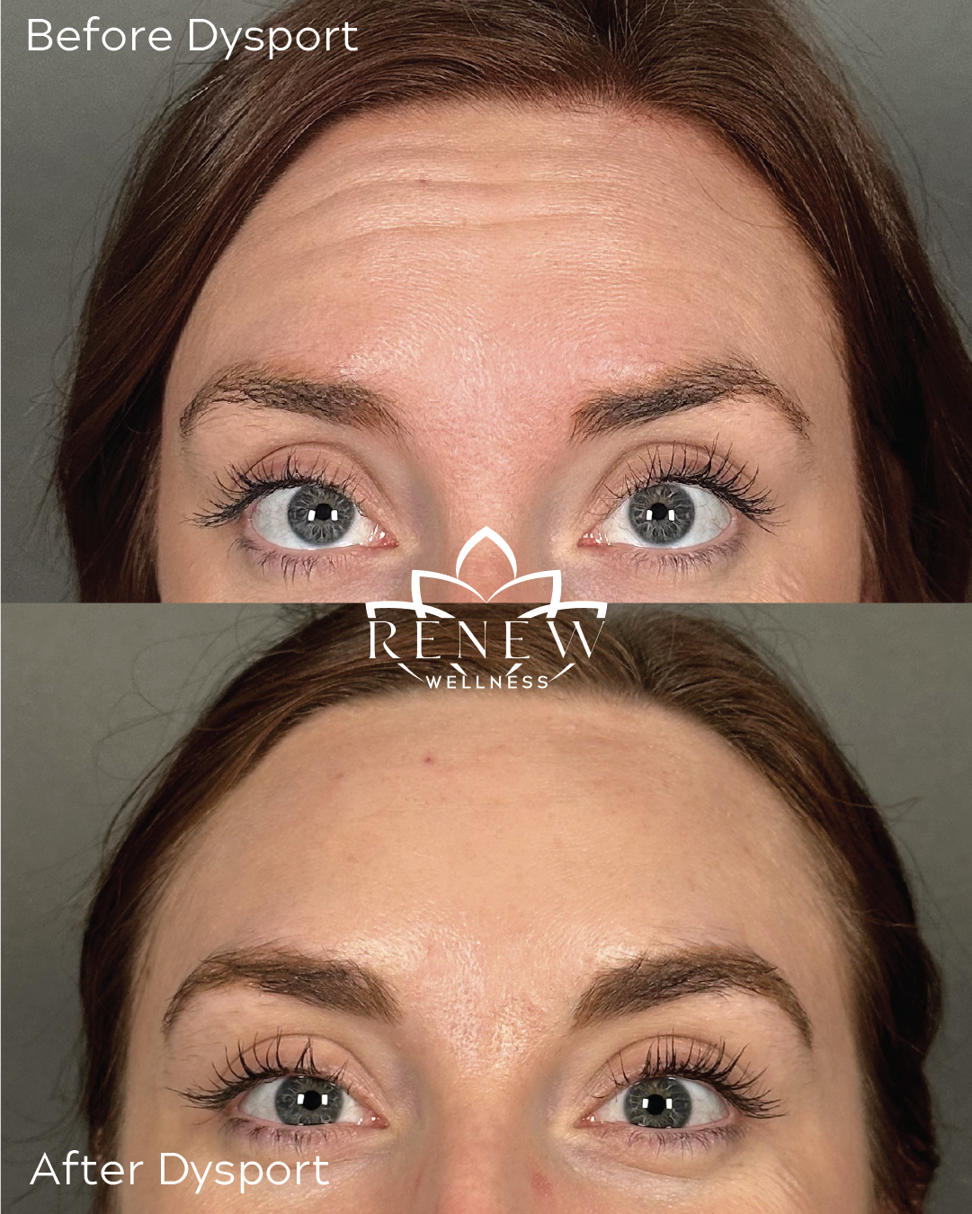 Dysport before and after showing a smoother forehead appearance