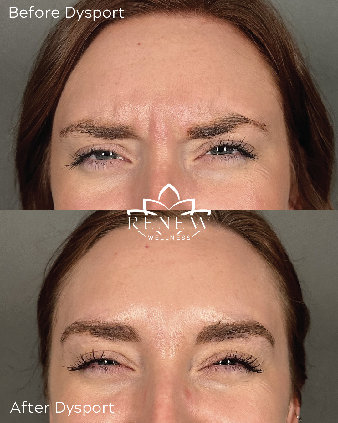 Dysport before and after showing softened frown lines between the brows