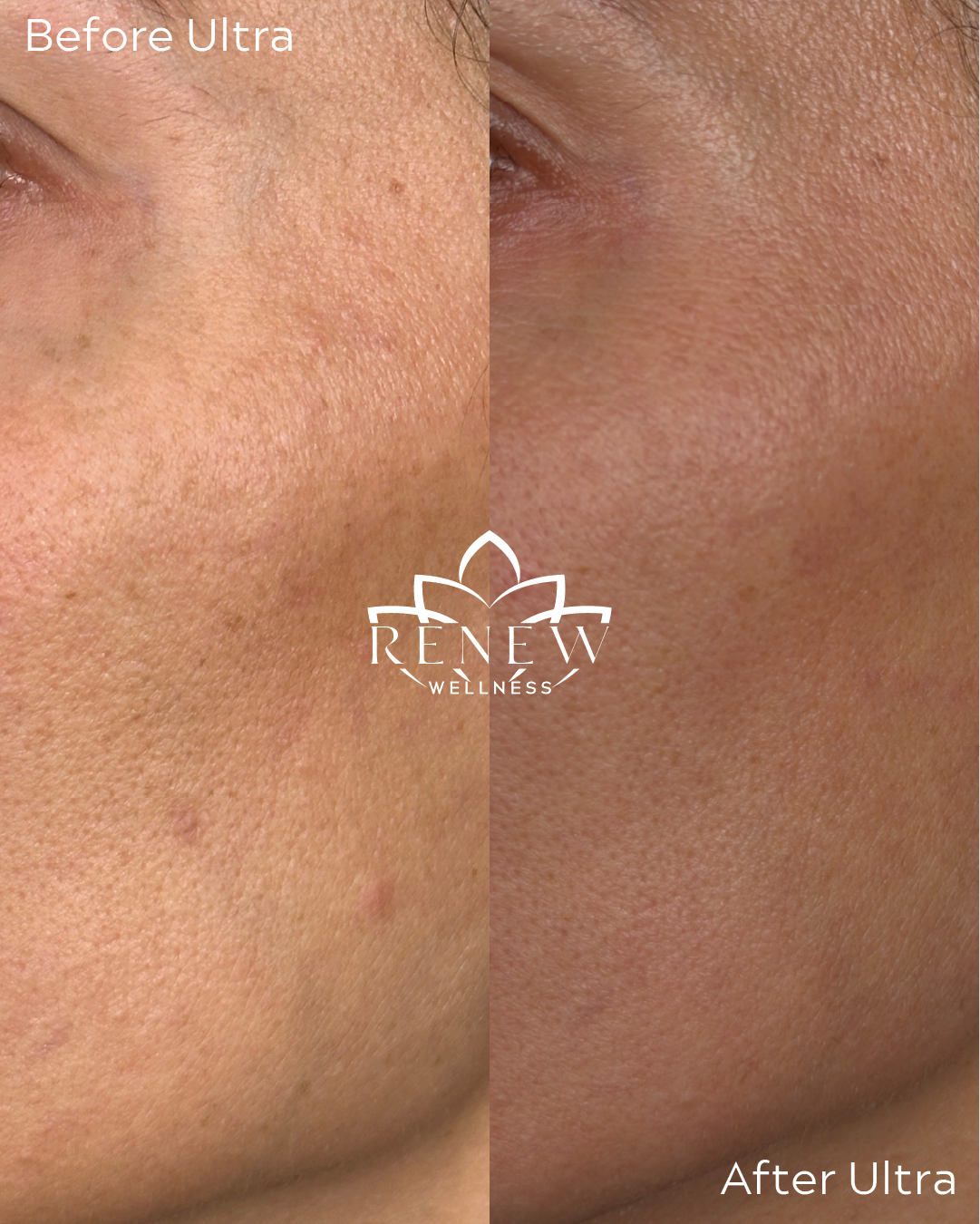 LaseMD Ultra before and after showing improvement in fine texture and tone on the cheek