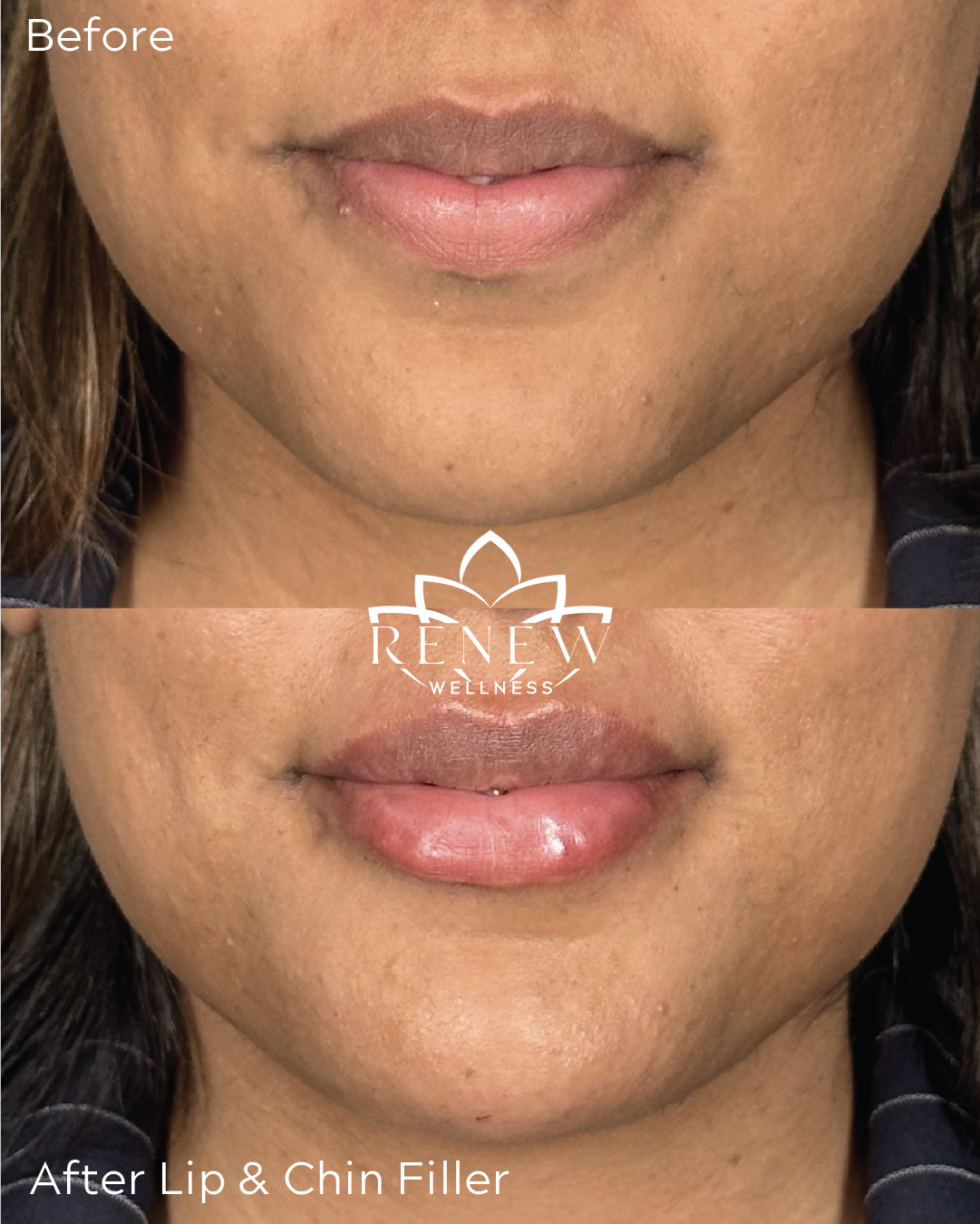 Lip and chin filler before and after showing fuller lips and refined chin shape