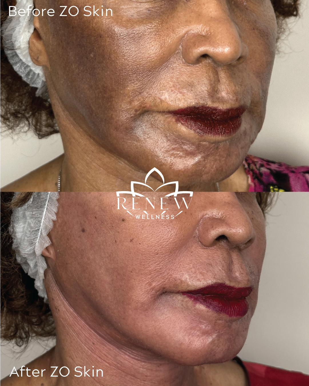 ZO Skin before and after result showing improvement in tone and texture