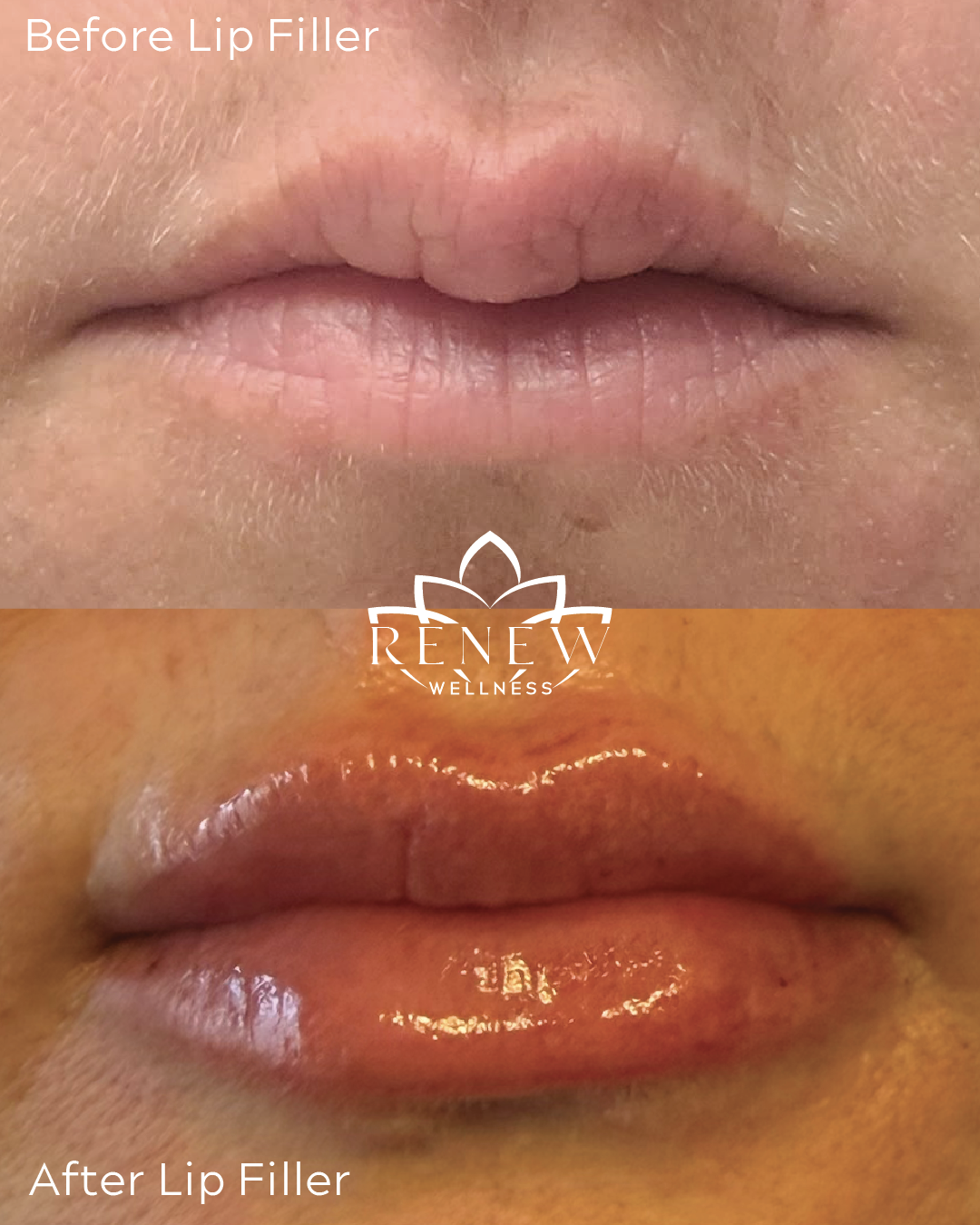 Lip filler before and after result 7 showing fuller, more defined lips