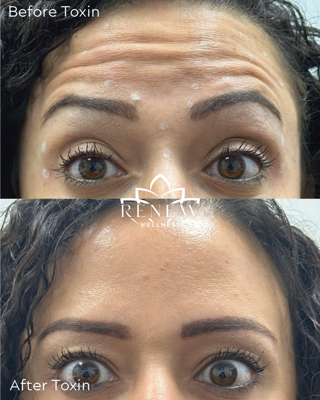 Daxxify before and after showing softened forehead lines