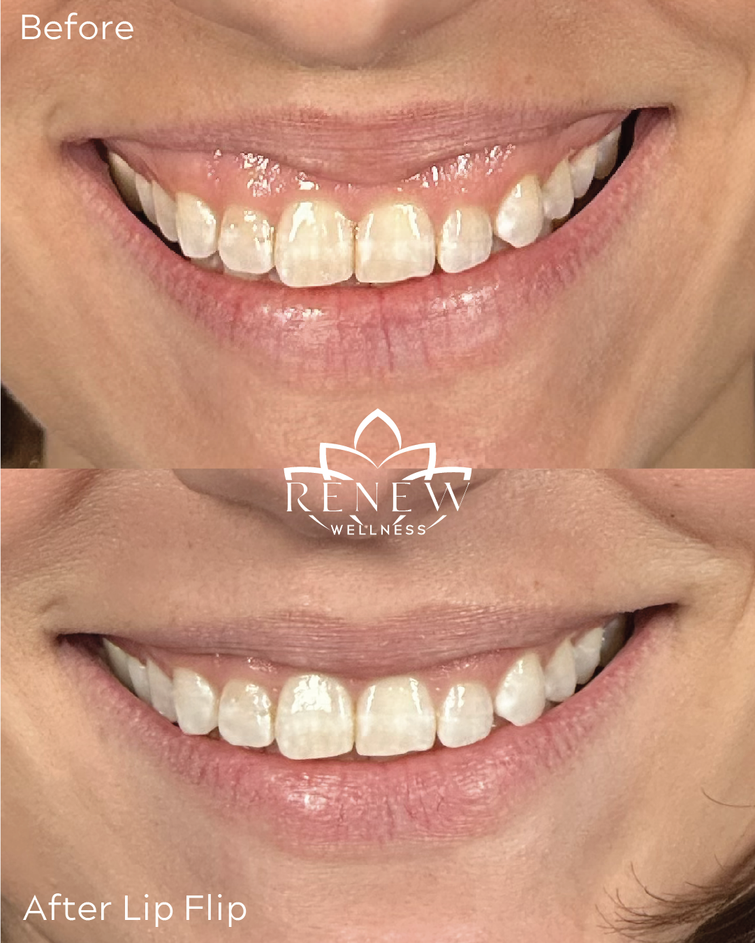 Lip flip before and after showing a reduced gummy smile