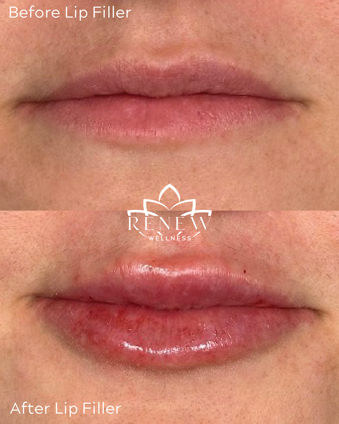 Lip filler before and after result 1 showing fuller, more defined lips