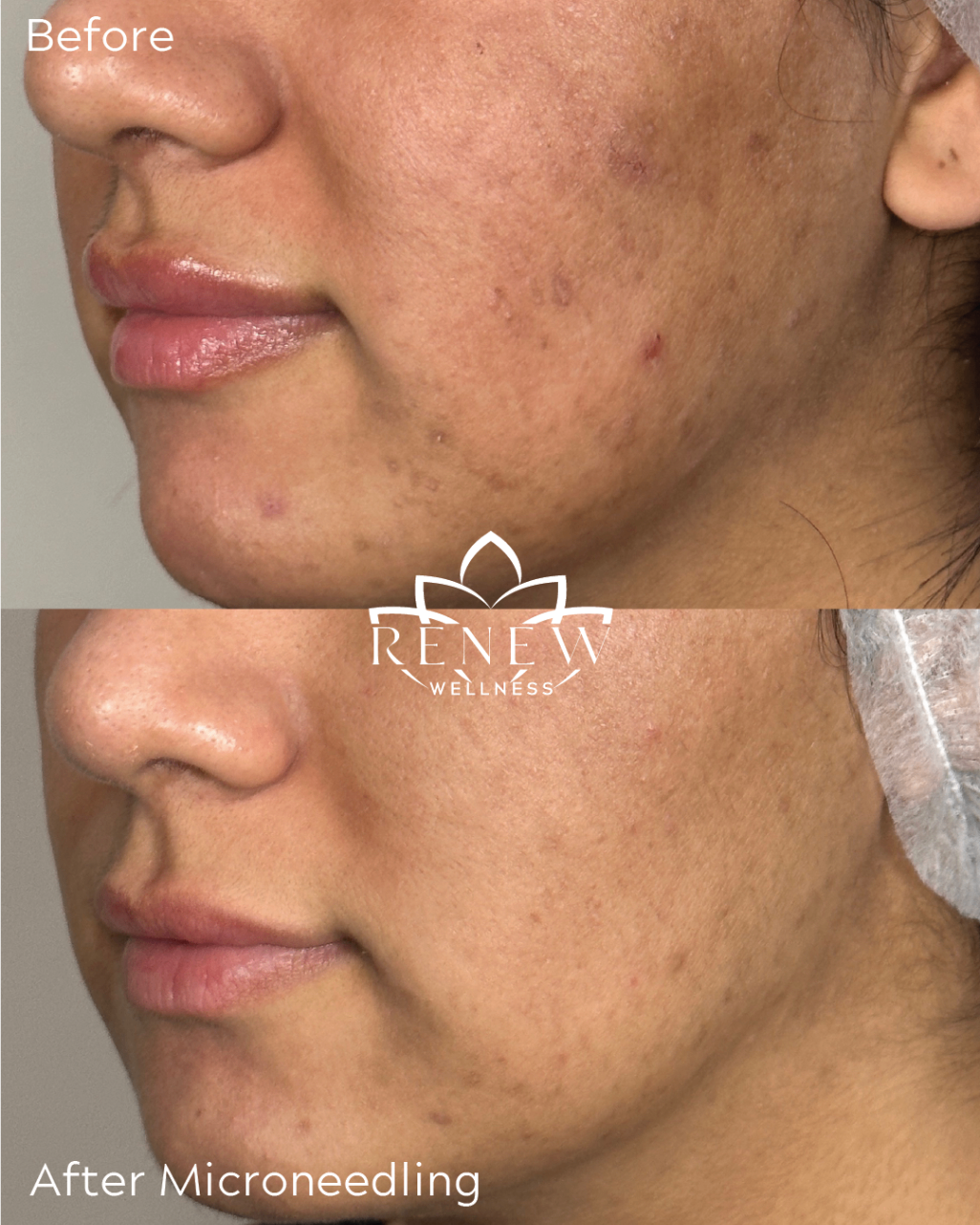 Microneedling before and after showing smoother skin texture and reduced breakouts