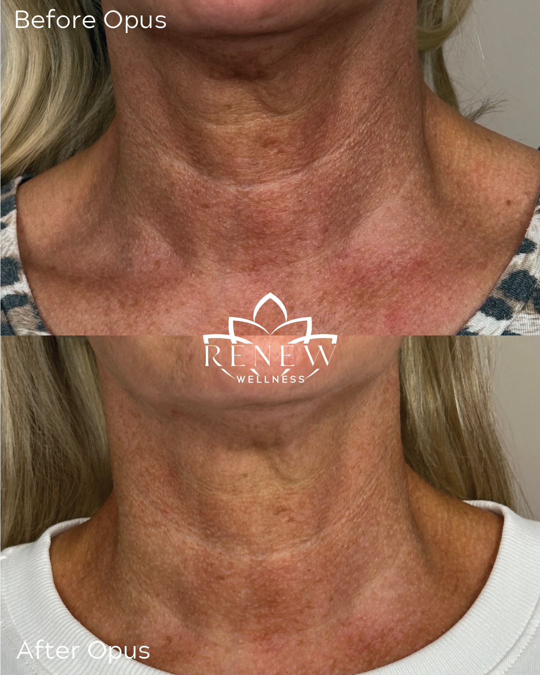 Opus laser before and after showing improvement in neck texture and tone