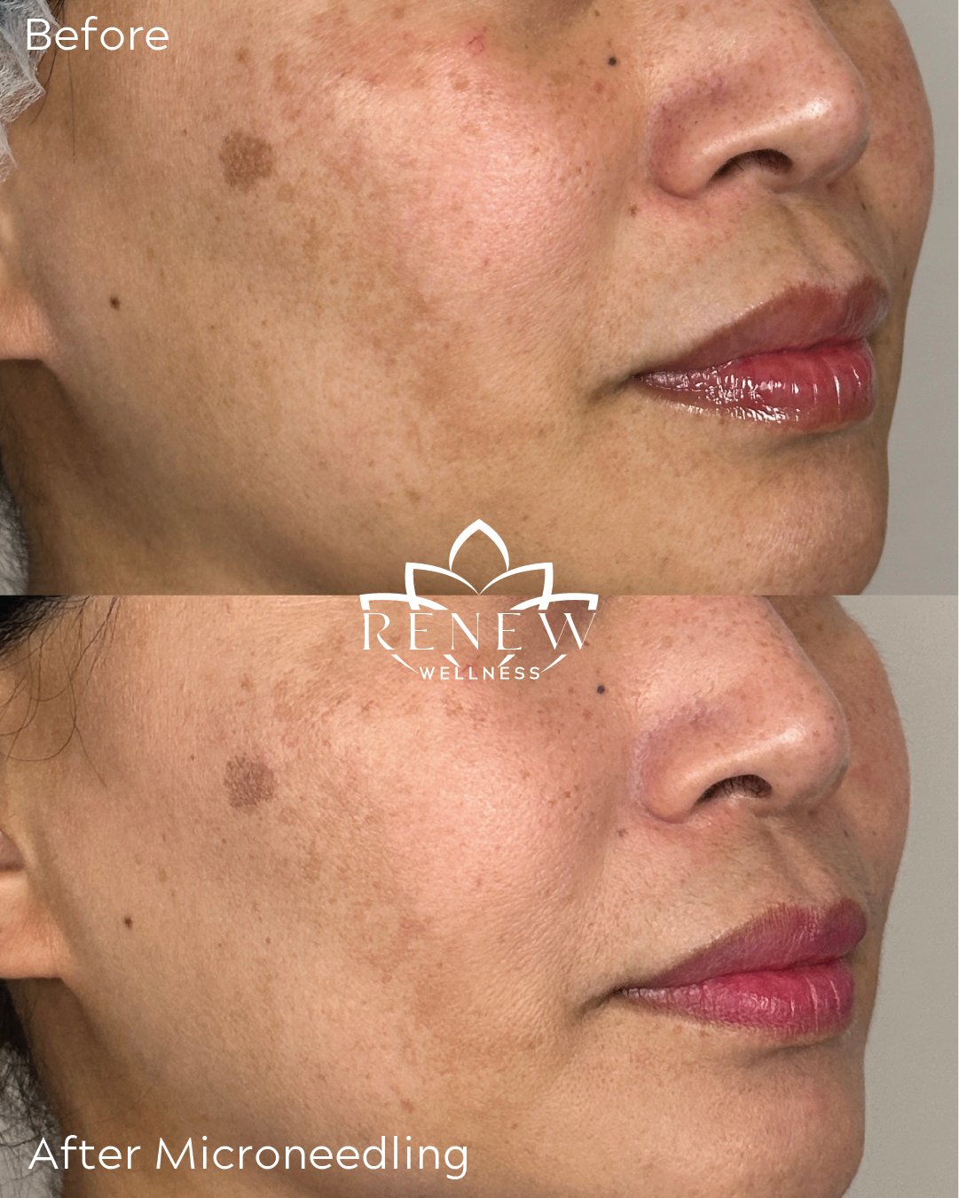 Microneedling before and after improving sun spots and tone