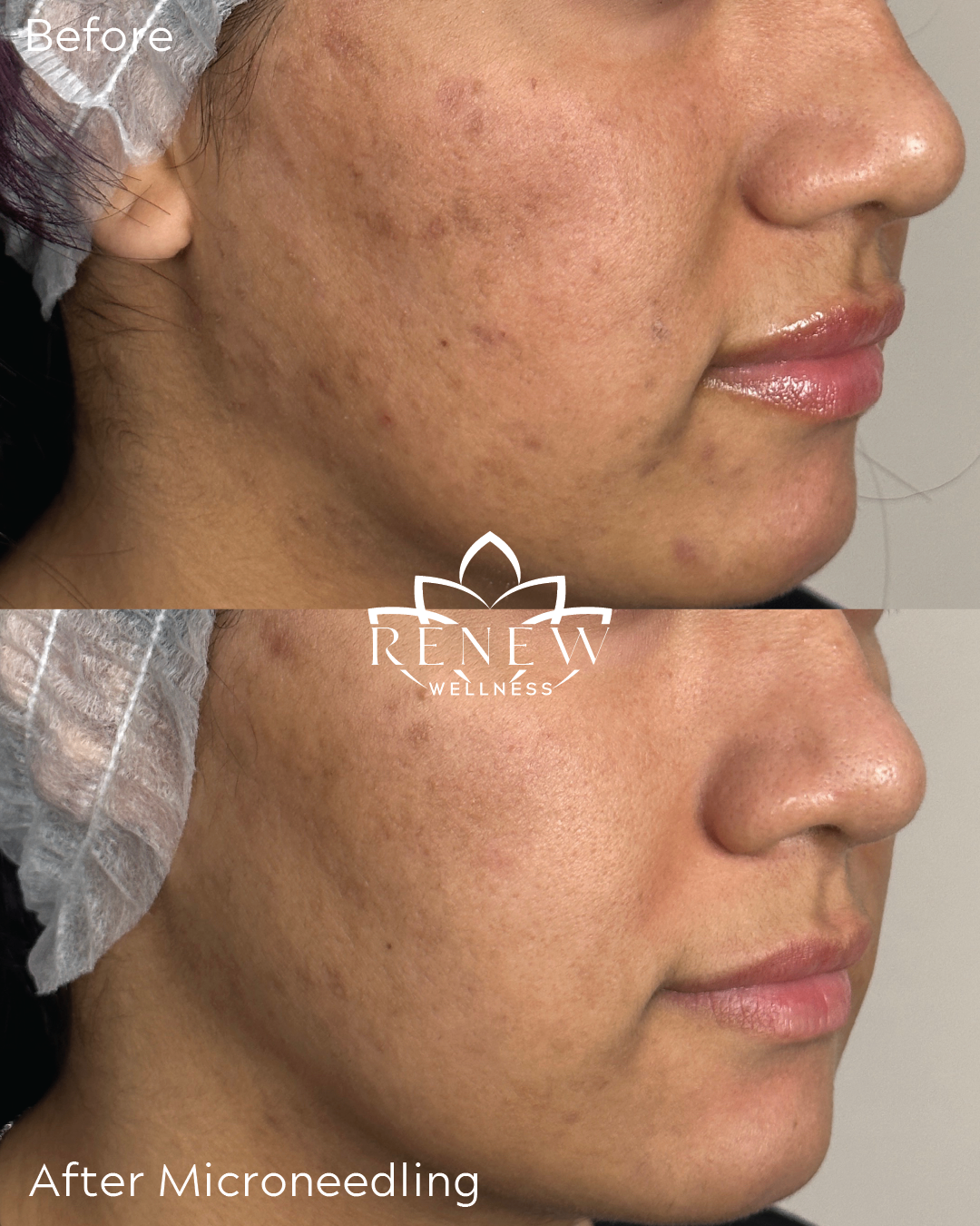 Microneedling before and after result showing clearer and smoother skin