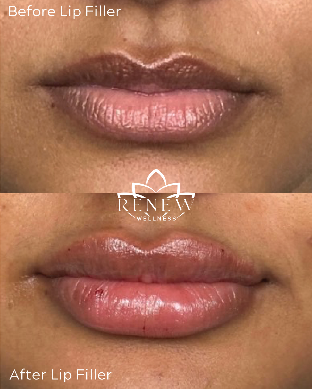Lip filler before and after result 6 showing fuller, more defined lips