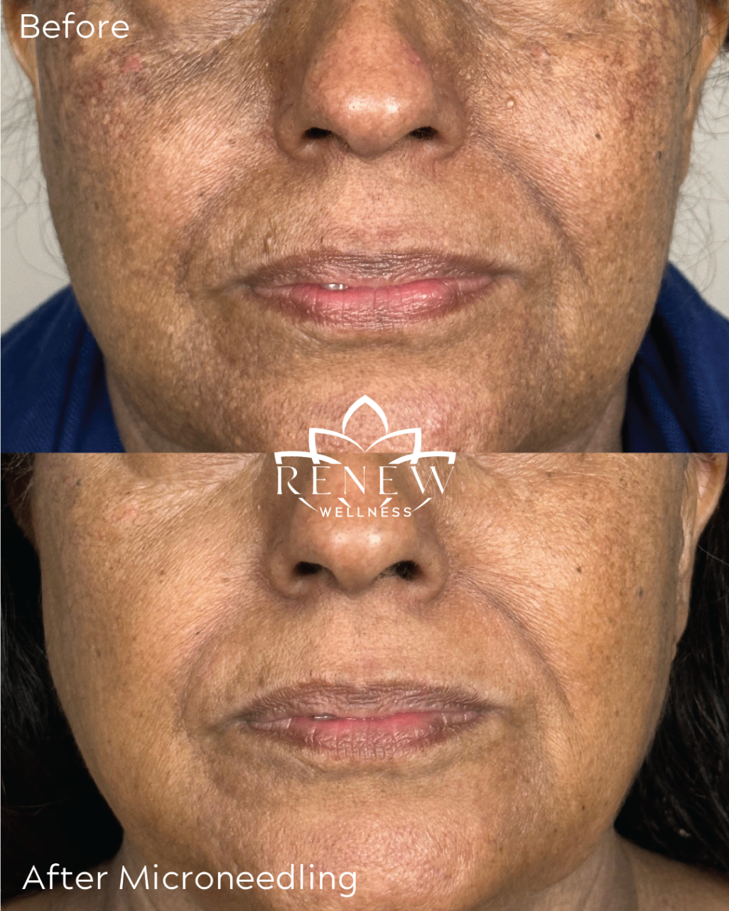 Microneedling before and after along the lower face and neck