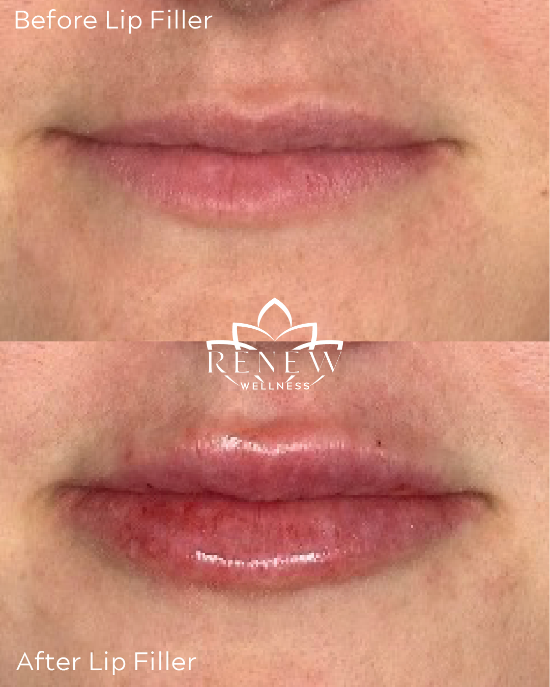 Lip filler before and after result 5 showing fuller, more defined lips