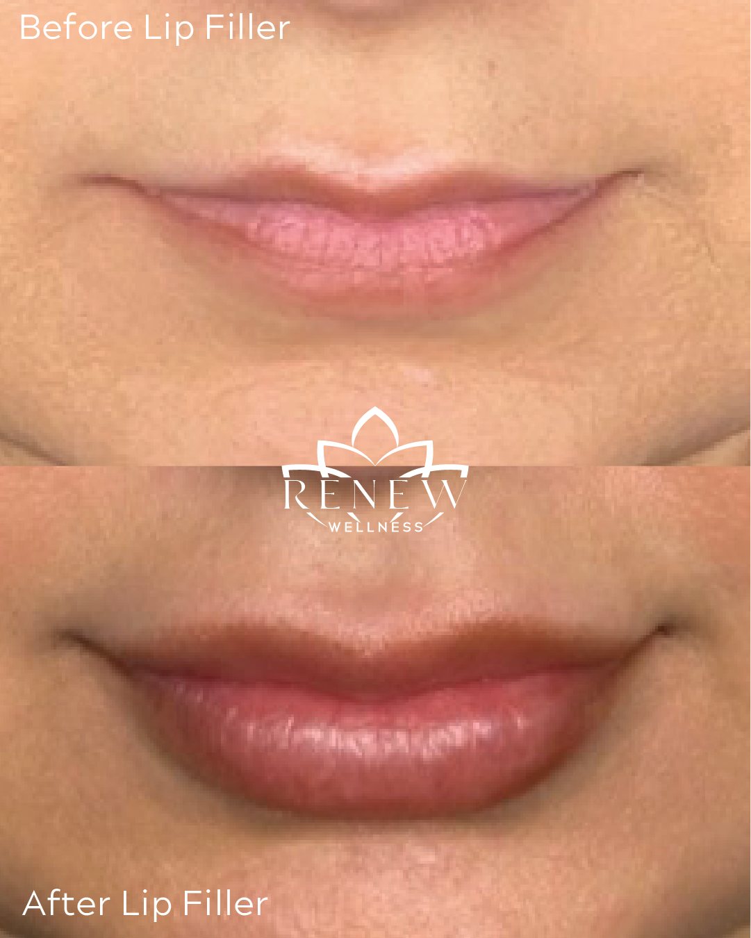 Lip filler before and after result 2 showing fuller, more defined lips