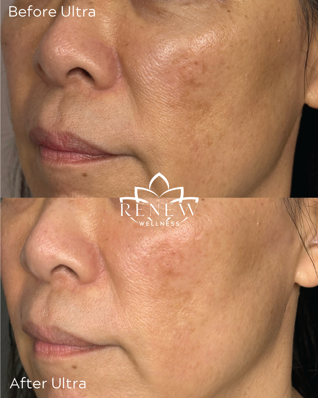 LaseMD Ultra before and after showing smoother cheek texture and a firmer-looking jawline