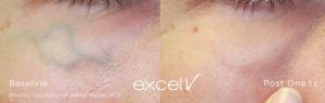 Laser Vein Removal excelV