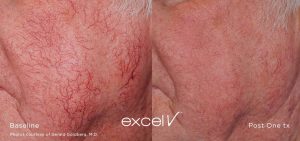 Laser Vein Removal Telagiectasia