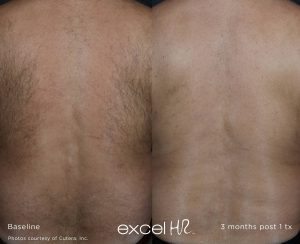 Laser Hair Removal Before and After Back